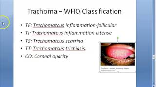 Ophthalmology 076 d Trachoma WHO Classification FISTO [upl. by Narahs]