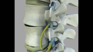 Back Pain amp Spinal Arthritis Treatment with NonSurgical Spinal Decompression [upl. by Oneill]