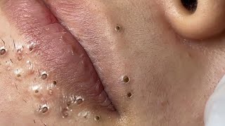 Big Cystic Acne Blackheads Extraction Blackheads amp Milia Whiteheads Removal Pimple Popping  9248 [upl. by Ihteerp]