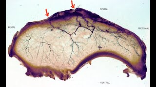 Scaphoid fracture Blood supply and Avascular necrosis [upl. by Llehcor]