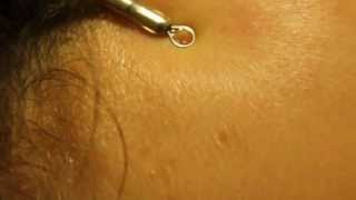 Blackhead extraction with Slow Motion HD  forehead zit [upl. by Eirolam385]