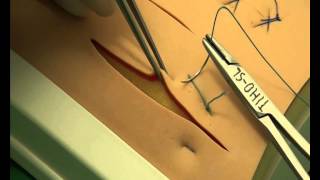 CSL Horizontal mattress sutures [upl. by Noimad]