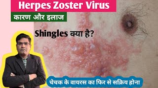 Herpes Zoster Shingles Disease Cause Symptoms and Treatment in Hindi  Varicella Zoster Virus [upl. by Akilaz]