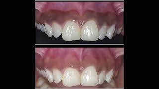 Gingival Depigmentation using scalpel [upl. by Yerffej798]