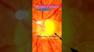 Myopic Crescent  Fundus Photography  Tesselations  Short Video 100 [upl. by Killen]