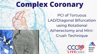 PCI of Tortuous LADDiagonal Bifurcation using Rotational Atherectomy amp MiniCrush Technique Nov 2023 [upl. by Maryn315]