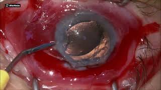 Explanting an AC IOL by scleral tunnel [upl. by Yelir]