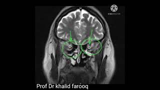 Benignidiopathic intracranial hypertension [upl. by Ahsila]