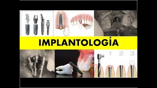 quotIMPLANTOLOGÍA INTEGRADAquot [upl. by Kcirtapnhoj112]