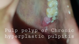 Pulp polyp or Chronic hyperplastic pulpitis [upl. by Eerhs]