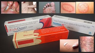 Antifungal Creams  इस्तेमाल करे क्रीम नहीं रहेगा कोई फंगल इन्फेक्शन ना रहेगा कोई भी दाग का निशान [upl. by Eerol]