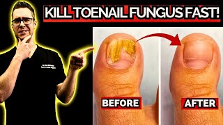 10 BEST Natural Toenail Fungus Home Remedies [upl. by Dimitry]