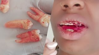 My GRAPHIC teeth extraction experience [upl. by Brendon]