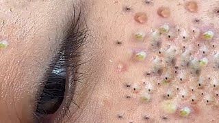 Big Cystic Acne Blackheads Extraction Blackheads amp Milia Whiteheads Removal Pimple Popping  8302 [upl. by Lumbard]