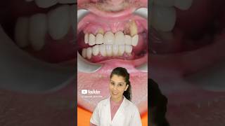 Fixed teeth through implants supported dentureshorts viralvideo implants dental implantdenture [upl. by Yerffe]