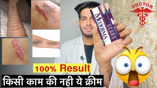 Mederma cream  Mederma advanced scar gel review  Mederma cream ke fayde  किसी काम की नही क्रीम 😱 [upl. by Aisyla]