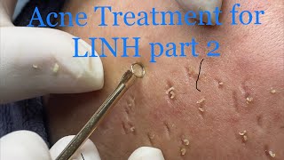 75  2024 PART 2 LINH Women have many acne hidden in their skin [upl. by Sokram]