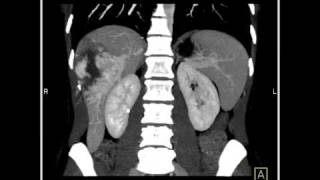 Abdomen Liver Cavernous Hemangioma of the Liver8 of 9 [upl. by Gussie695]