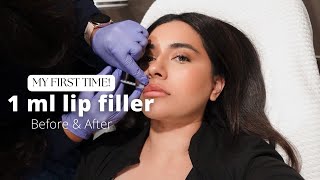 I GOT LIP FILLERS FOR THE FIRST TIME  1ML [upl. by Chi]