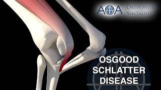 AOA Orthopedic Specialists  OsgoodSchlatter Disease [upl. by Neelear851]