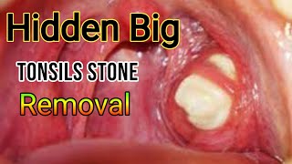 Tonsils stone removal tonsillolith removal Tonsillitis [upl. by Llennaj363]