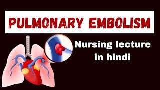 Pulmonary Embolism in hindi  cause pathophysiology symptoms management  nursing lecture [upl. by Bound275]