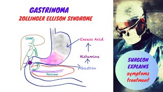 Gastrinoma  Zollinger Ellison Syndrome [upl. by Anahsahs880]