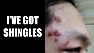 Ive Got SHINGLES On My Face and Eye [upl. by Aneloj]