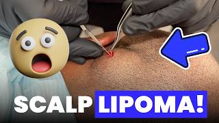 SCALP LIPOMA [upl. by Ardnaskela]