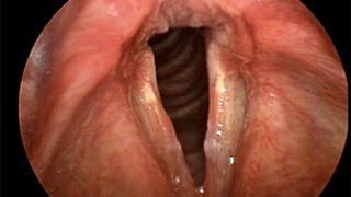 Laryngitis  a patient education video [upl. by Eirret]