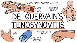 Understanding De Quervain’s Tenosynovitis Mummy Thumb [upl. by Licastro]