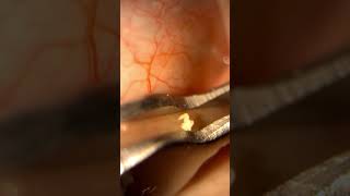 Surprising first time eyelid gland expression [upl. by Payson]