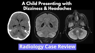 Radiology Case Review  A Child Presenting with Dizziness amp Headaches [upl. by Os]