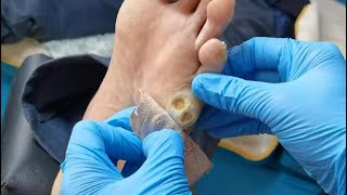 Pedicure Tutorial How to treat plantar wart Plantar wart removal Two warts on the sole [upl. by Lenahc]