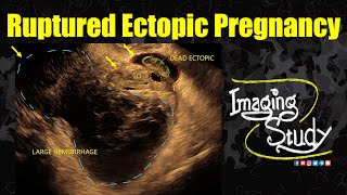 Ruptured Ectopic Pregnancy  TVS  Ultrasound  Case 344 [upl. by Otirecul]