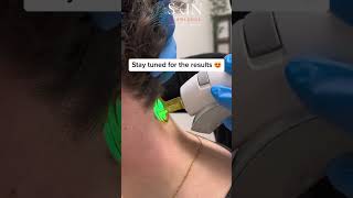 Neck Laser Hair Removal [upl. by Erkan]