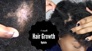 5 Power Tips to Grow Natural Hair  Traction Alopecia [upl. by Dyl]