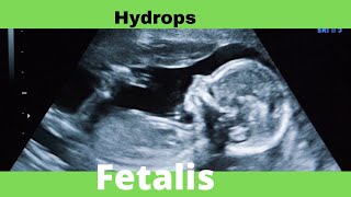 Hydrops Fetalis  Ultrasound  Anomaly  Case [upl. by Rapsac]