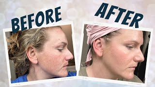 How I Treat My Melasma  ITS WORKING 😱🙌 [upl. by Naot]