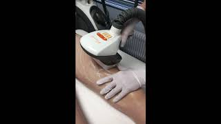 Traitement de la Cellulite à Lyon par Velashape ® [upl. by Laehcor]