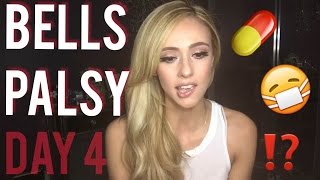 Bells Palsy Recovery and Home Remedies Ive been trying  Day 4 [upl. by Denney]