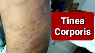 Tinea Corporis  WideSpread [upl. by Hermia]