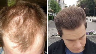 How To Distinguish Between Androgenetic Alopecia And Telogen Effluvium [upl. by Waylen]