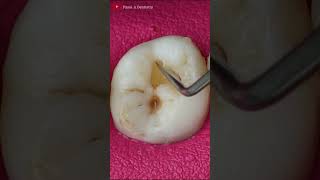 Small Teeth Cavities toothrestoration satisfying [upl. by Ellicott]