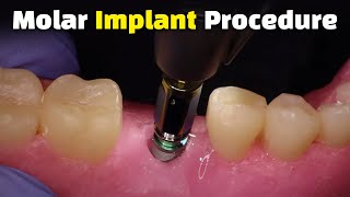 Step by Step Dental Implant Procedure  Back Molar [upl. by Nauhs661]