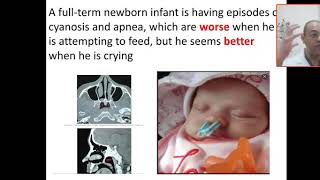 Case 152 cyanosis improved with crying choanal atresia CHARGE syndrome catheter not passage nos [upl. by Perdita]