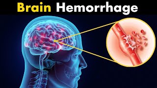 What Happens in Brain hemorrhage  Symptoms Causes and Treatment 3d animation [upl. by Yezdnil]