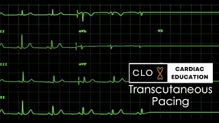 Transcutaneous Pacing [upl. by Reinaldo]