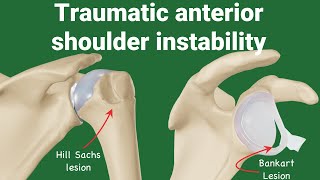 Pathologies of Traumatic Anterior Shoulder Instability TUBS animation [upl. by Ahtar]