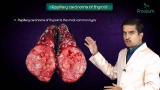 Thyroid neoplasms part 1  Papillary carcinoma of thyroid   Endocrine pathology [upl. by Alexandr]